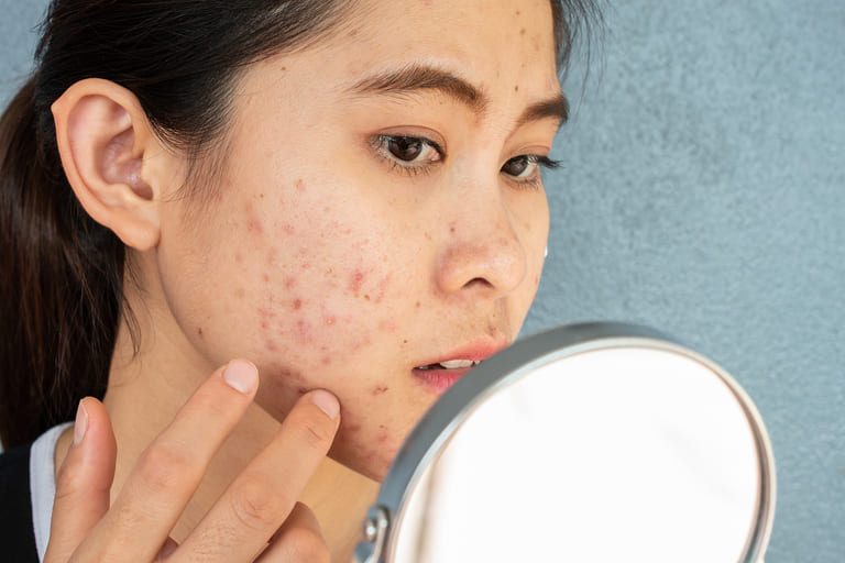 cách trị mụn bằng hồ nước