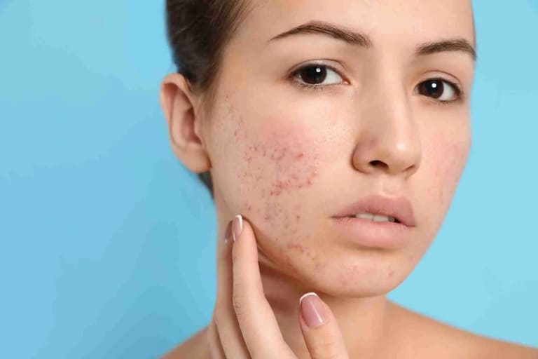 cách trị mụn thâm bằng mỡ trăn