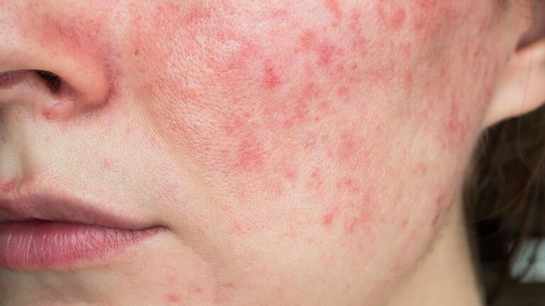 cách trị vết đỏ sau khi nặn mụn