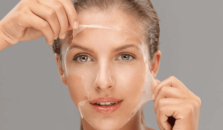 có nên peel da sau khi nặn mụn